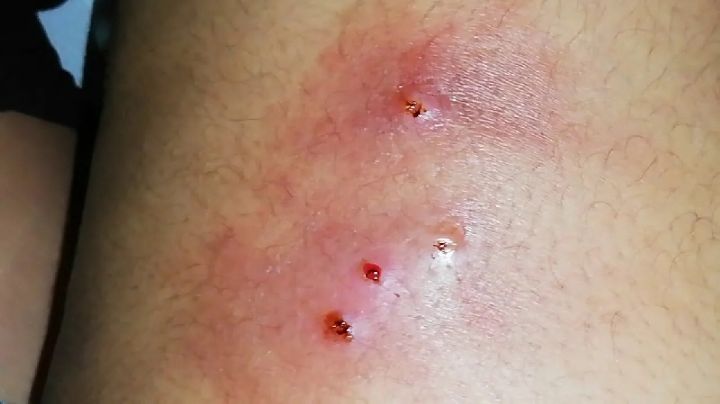 Secretaría de Salud de Chiapas confirma 21 casos humanos de miasis por gusano barrenador