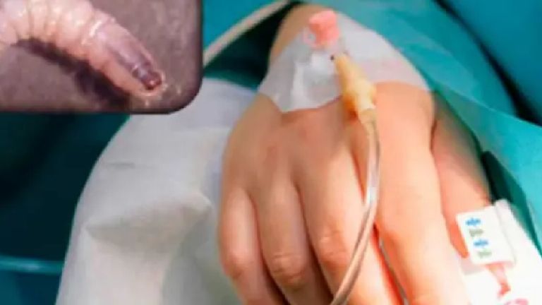 Secretaría de Salud de Chiapas confirma 21 casos humanos de miasis por gusano barrenador