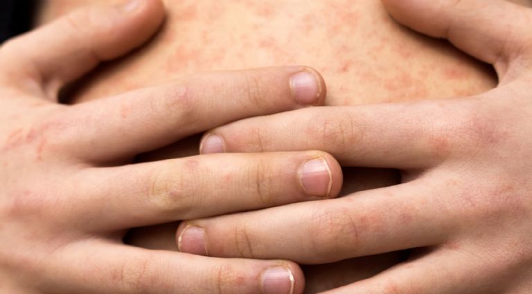 Se espera que en noviembre 2025 México ya no tenga casos de sarampión. Foto: Facebook