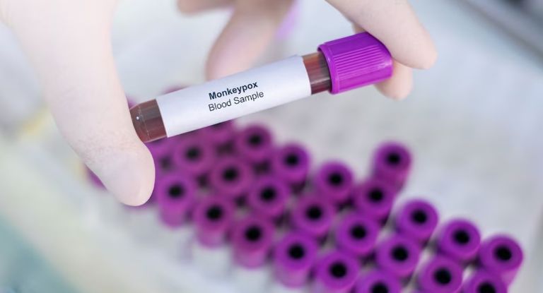  viruela símica (Mpox)