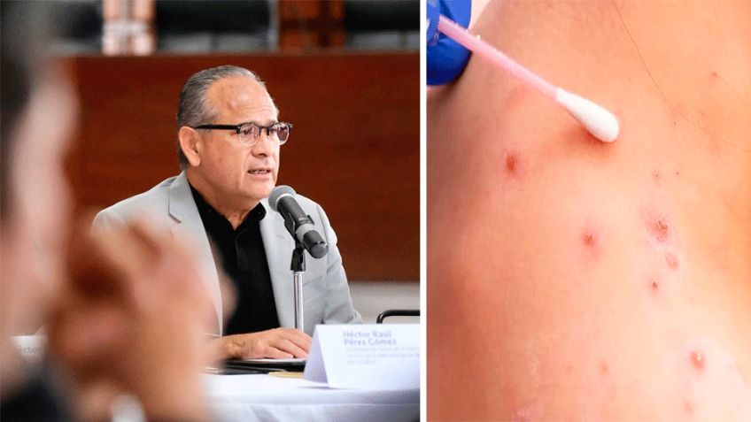 México: Primer muerto por viruela del mono en Jalisco, informó Secretaría de Salud