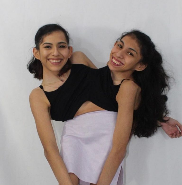 ¿Quiénes son Carmen y Lupita, hermanas siamesas?