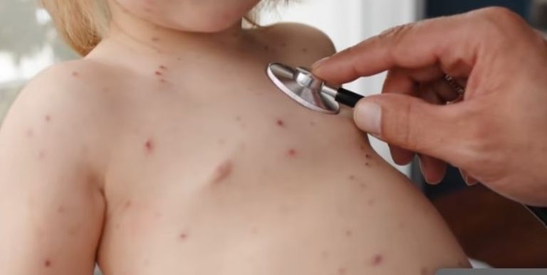 Los niños son los más afectados 