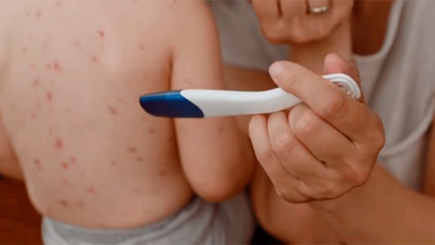 Secretaría de Salud: México supera los 4 mil casos de sarampión hasta el 11 de agosto