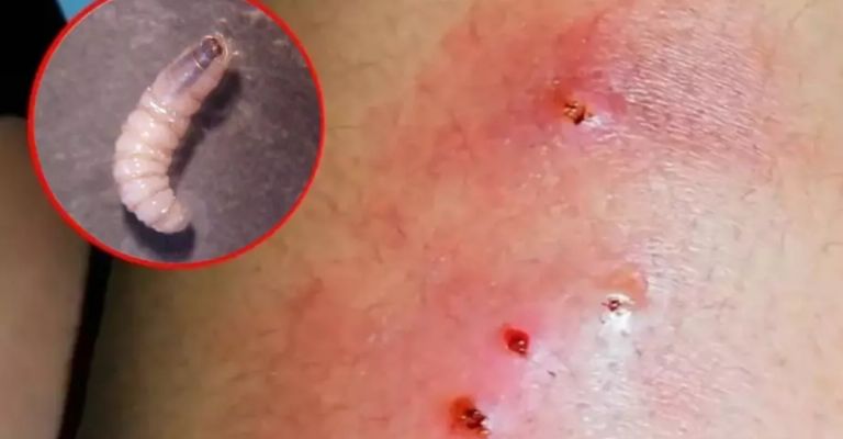 Primer caso humano de gusano barrenador en Yucatán