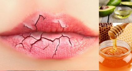 ¿Labios resecos y agrietados? Estos remedios naturales podrían solucionar el problema