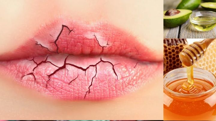 ¿Labios resecos y agrietados? Estos remedios naturales podrían solucionar el problema
