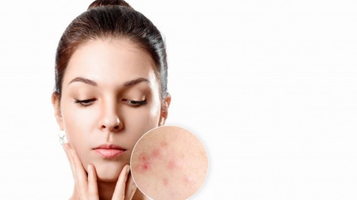 ¿Mucho acné? El estrés podría ser la principal causa de que tu piel tenga problemas