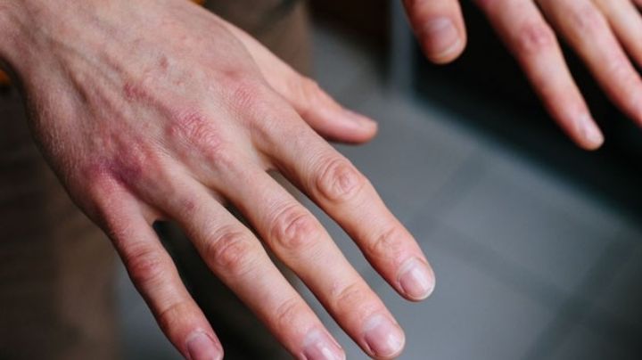 Covid-19: Tener manchas en la piel podría ser un síntoma asociado al coronavirus