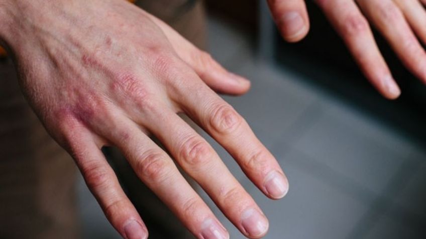 Covid-19: Tener manchas en la piel podría ser un síntoma asociado al coronavirus