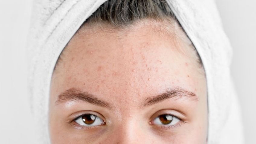 ¿Acné? Estos son los productos que debes usar a la hora de maquillarte