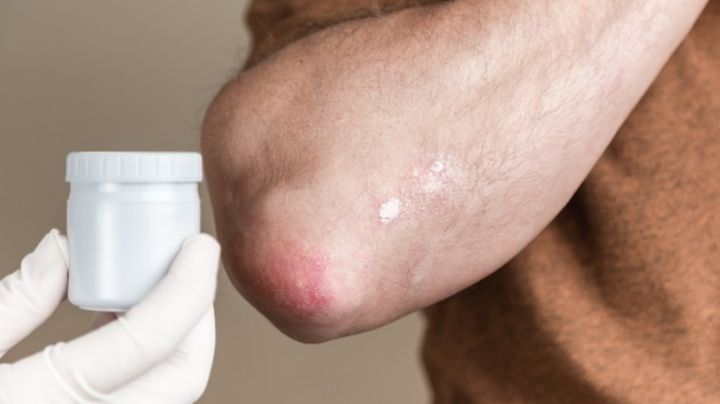 ¿Problemas en la piel? Conoce los usos y efectos secundarios de la betametasona