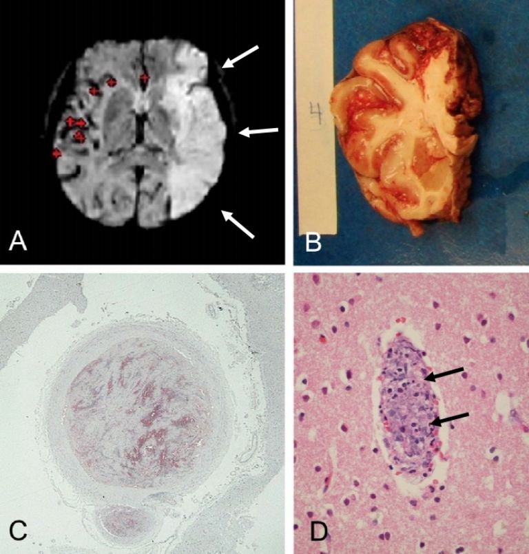Mapping of SARS-CoV-2 Brain Invasion and Histopathology in COVID-19 Disease