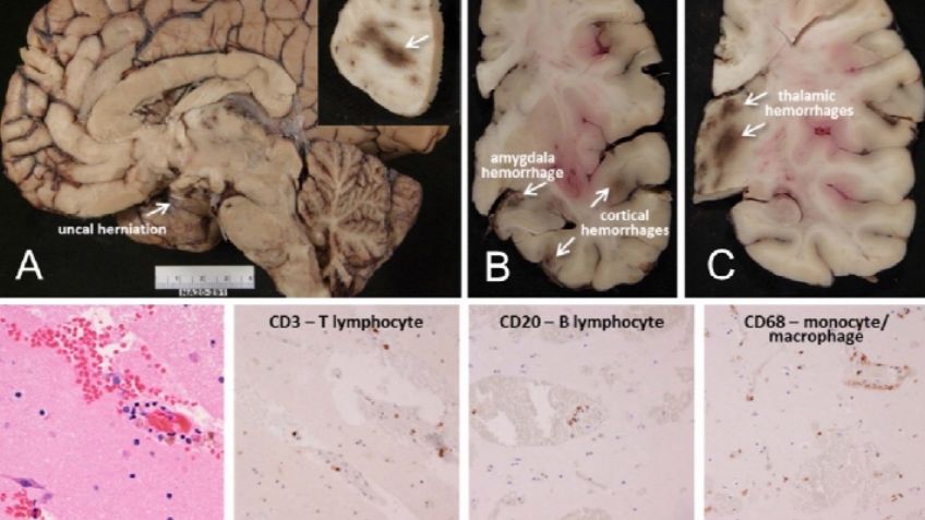 Covid-19: Revelan que el virus podría llegar al cerebro a través de la nariz y quedarse ahí