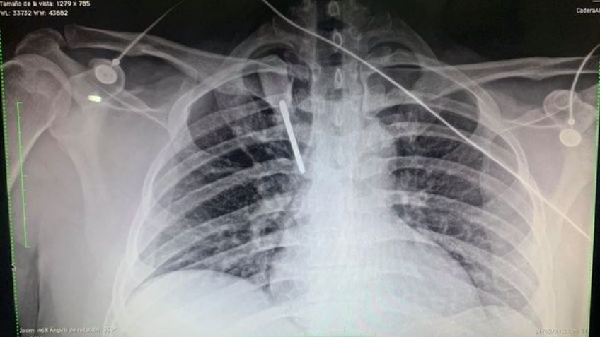 Terrible evento: Hieren de gravedad a médico del IMSS; le clavaron un desarmador