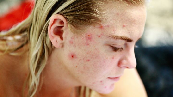 Estas son algunas de las razones por las que el acné aparece después de los 25 años