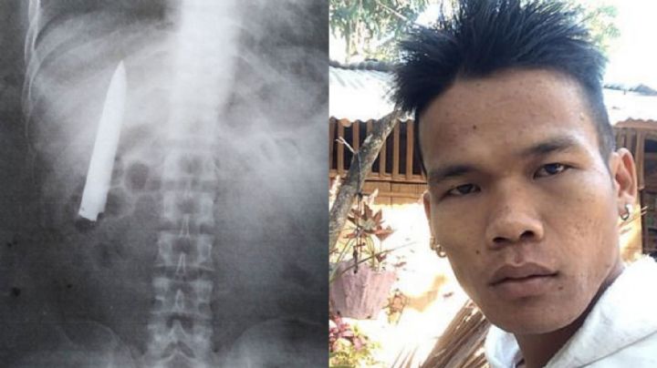 ¡De no creerse! Kent pasó más de un año con un cuchillo en el tórax sin darse cuenta