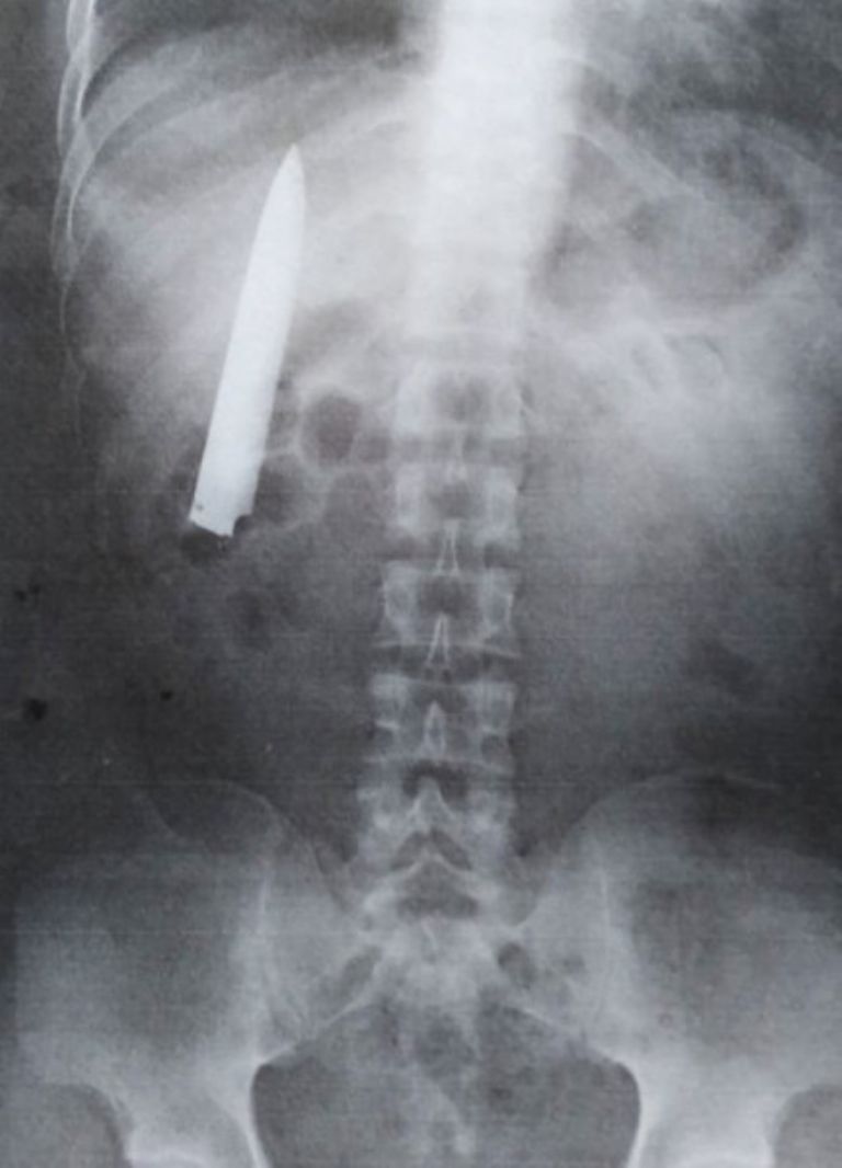 Kent Ryan pasó 15 meses con un cuchillo adentro