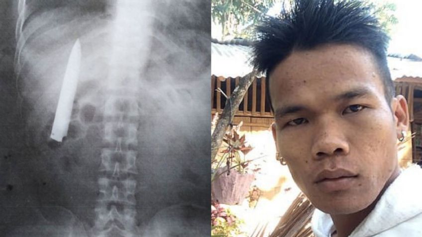 ¡De no creerse! Kent pasó más de un año con un cuchillo en el tórax sin darse cuenta