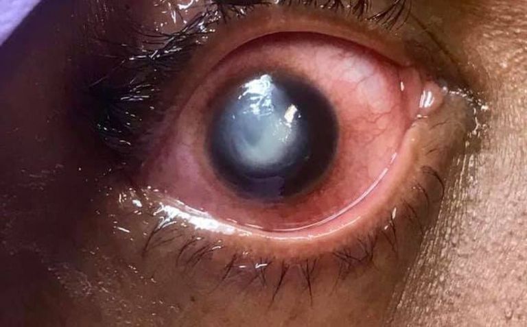 Usar lentes dde contacto puede traer graves consecuencias