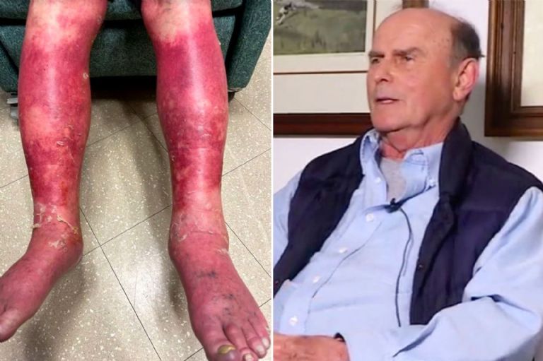 Vacuna provoca que se le despelleje la piel a Richard Terrell