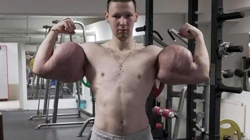 'Popeye': Joven ruso podría perder los brazos por inyectarse vaselina en los bíceps