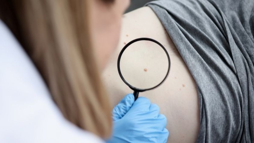 Este fármaco para la diabetes ayudaría en el tratamiento contra el cáncer de piel