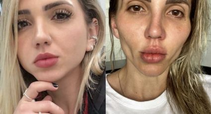 Influencer brasileña se desfigura el rostro tras realizarse una cirugía plástica