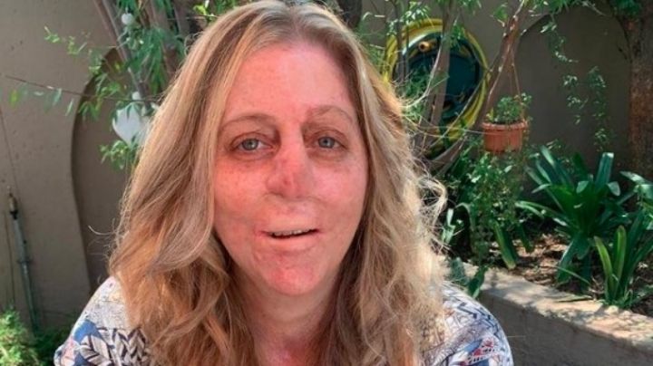 Shaninlea Visser perdió sus extremidades, labios y nariz por una mordida de mangosta