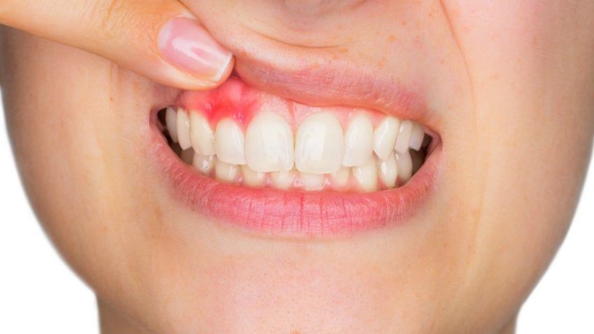 ¿Te sangran las encías? Ten cuidado, podrías tener gingivitis; estos son los síntomas