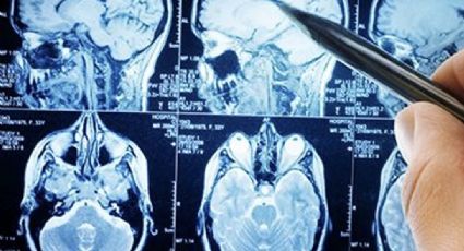 El 80% de los hospitalizados por Covid-19 sufren problemas neurológicos según estudio