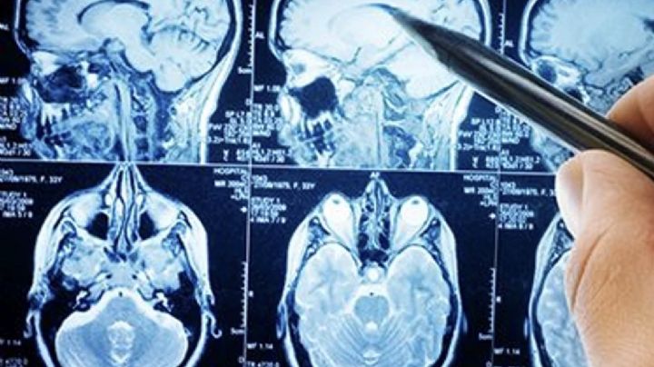 El 80% de los hospitalizados por Covid-19 sufren problemas neurológicos según estudio