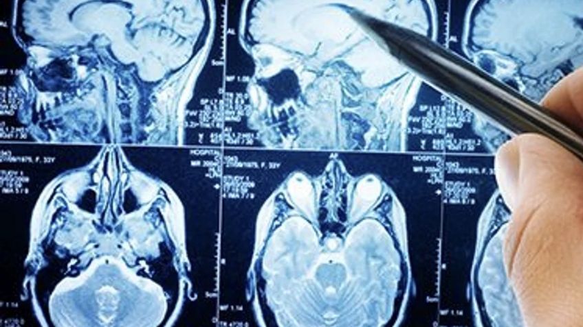 El 80% de los hospitalizados por Covid-19 sufren problemas neurológicos según estudio