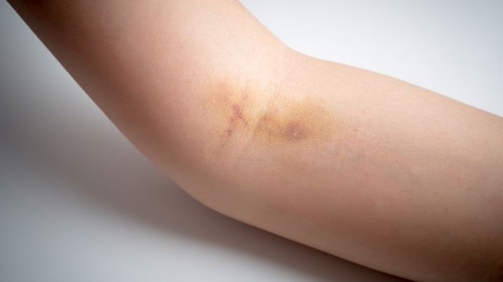 Covid-19: Expertos investigan los coágulos sanguíneos como un posible nuevo síntoma