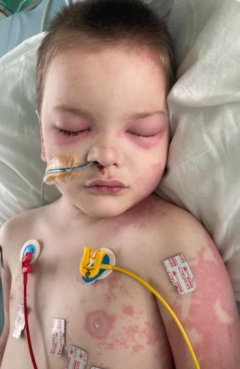 Oliver Patterson padece un extraño síndrome relacionado con Covid-19