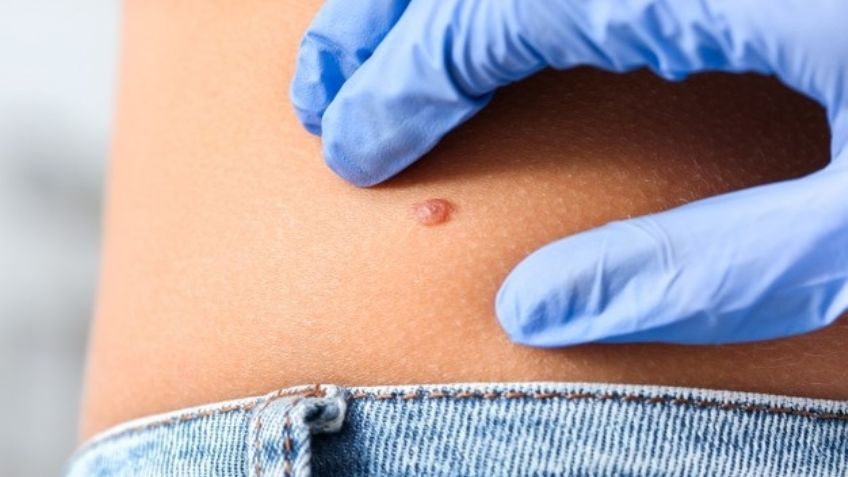 Día Mundial del Melanoma: Identifica las señales que pueden indicar esta terrible enfermedad