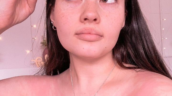 De no creer: Mujer sufre una extraña enfermedad que la hace alérgica ¡al agua!