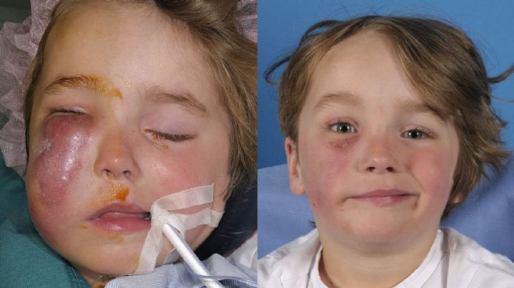 Niño de 4 años sufre parálisis facial tras ser mordido por una cobra escupidora en la cara