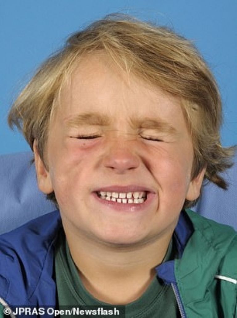 Niño de 4 años sufre parálisis facial; lo mordió una serpiente escupidora