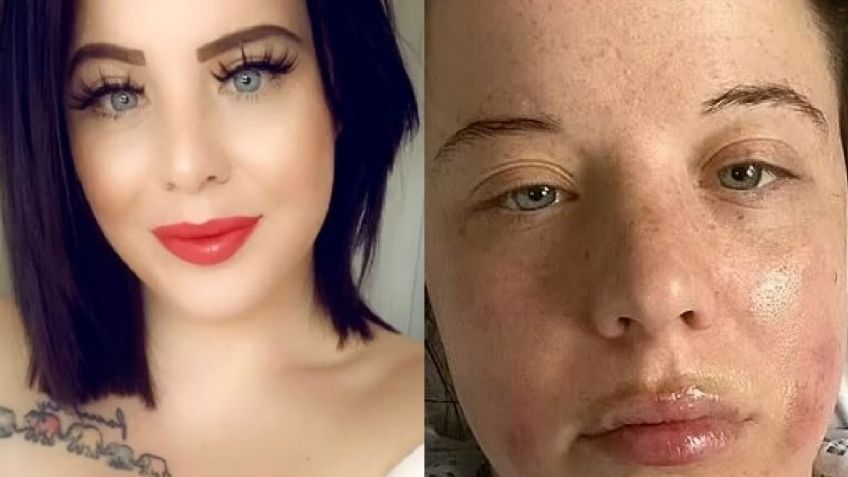 Tenebroso: Una mujer tiene una reacción rara a la vacuna de Pfizer; sufre diversas fracturas