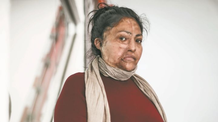 Hombre baña en ácido a su pareja y le desfigura el rostro; es detenido 7 años después