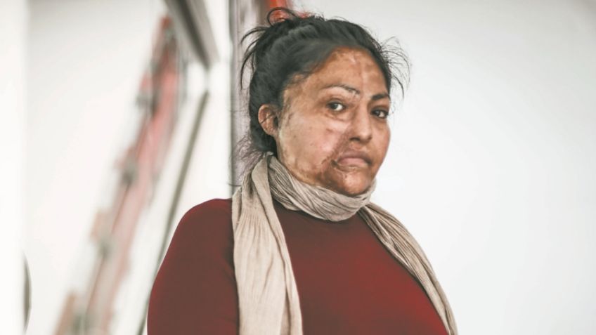 Hombre baña en ácido a su pareja y le desfigura el rostro; es detenido 7 años después