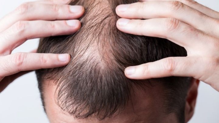 Inimaginable: Hombres con calvicie podrían ser vulnerables ante el Covid-19