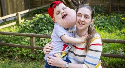 FOTOS: Él es Alex, el niño que nació con un quiste en la cara del tamaño de una toronja