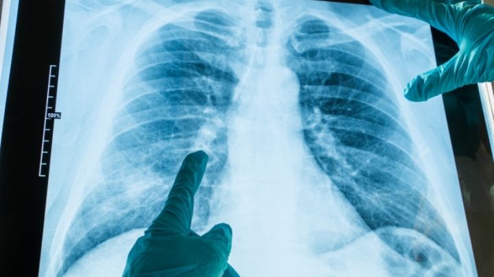 Covid-19: La neumonía bilateral sería la secuela más temida causada por el virus