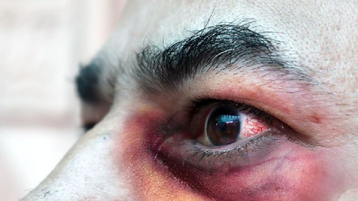 Descubre la verdad detrás de los 5 mitos detrás de la terrible infección por hongo negro