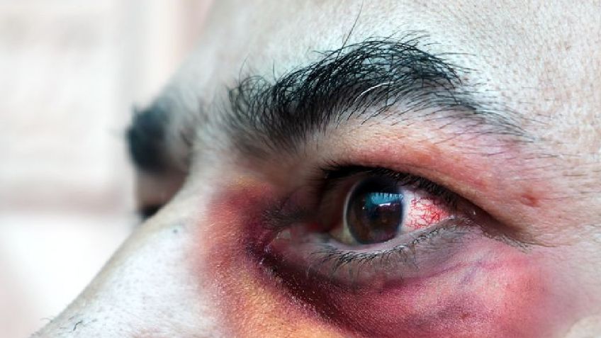 Descubre la verdad detrás de los 5 mitos detrás de la terrible infección por hongo negro