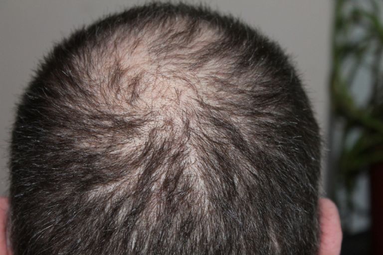 Calvicie 