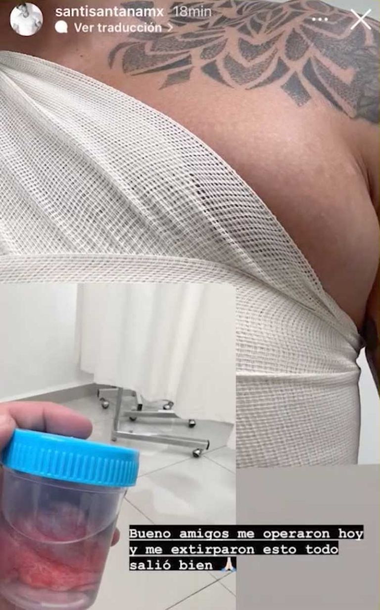 El tumor que le removieron tras la cirugía 