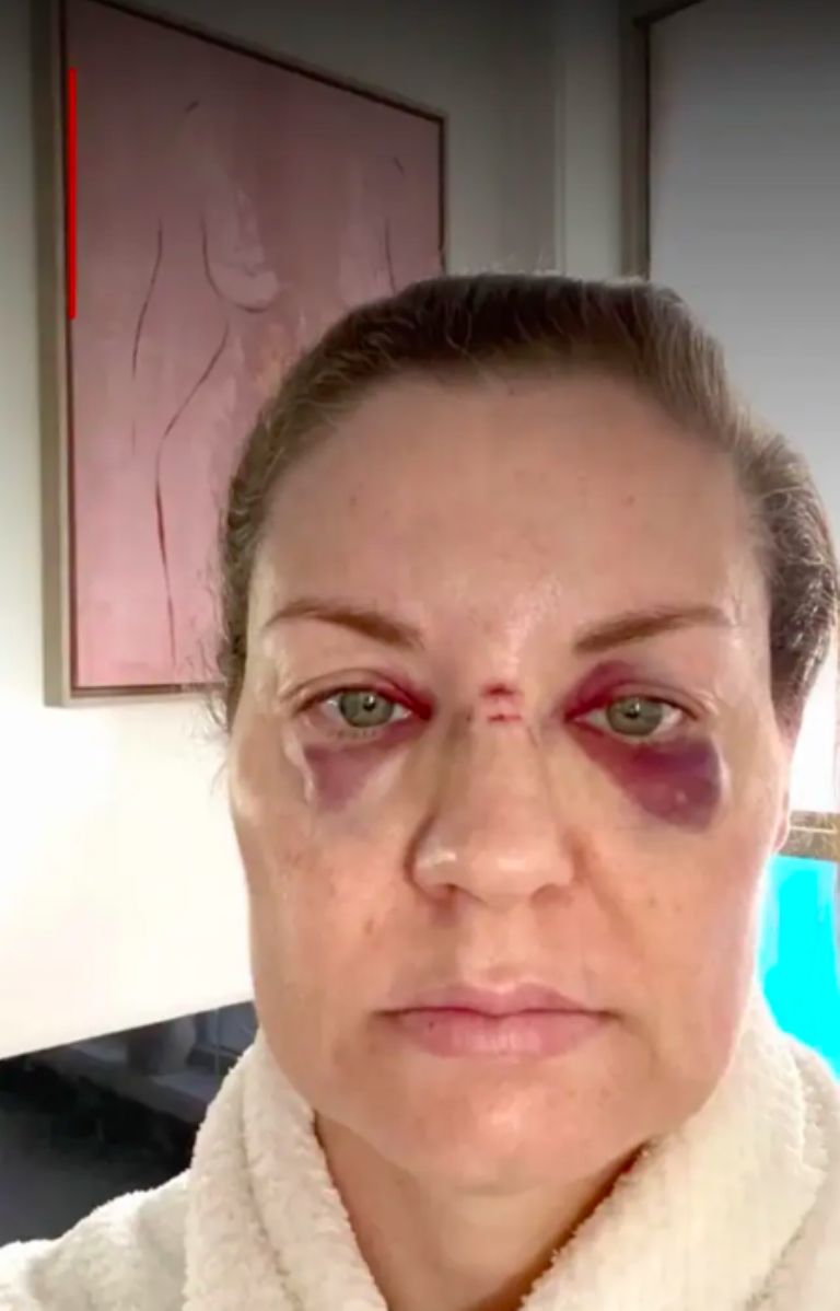 Lesiones de la fan de Guns n' Roses 